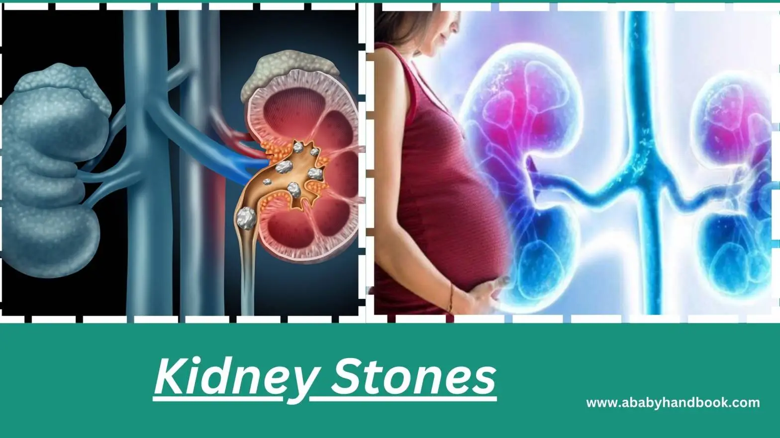 Kidney Stones Symptoms Pregnancy: What is Symptoms and Treatment?