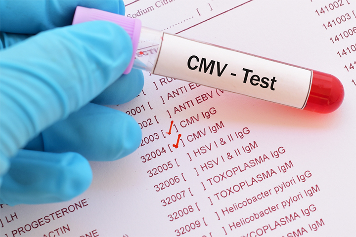 Babies Born With CMV: Symptoms, Causes And Treatment