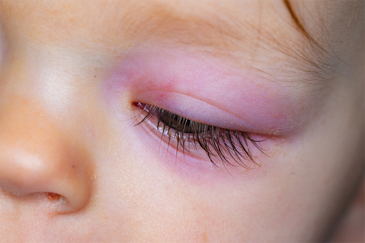 Swollen Eye in Babies: Causes, Treatment And Home Remedies