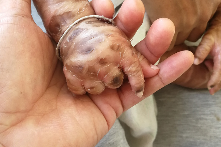 Harlequin Ichthyosis Baby